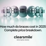How Much Do Braces Cost in 2025? Complete Price Breakdown